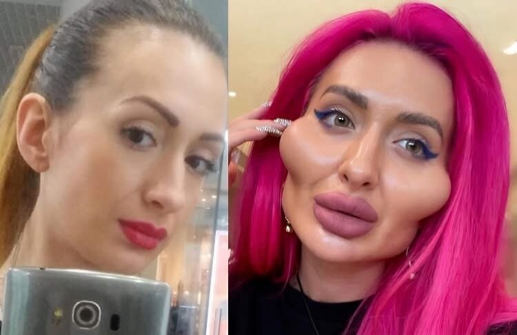 “ასე დაიმახინჯა ანამ თავი პლასტიკური ოპერაციებით” – ვინ არის გოგონა, რომლის ფოტოებმაც ინტერნეტსივრცე მოიცვა