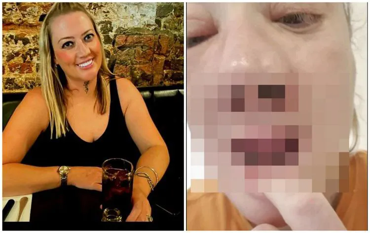 წარუმატებელი სტომატოლოგიური ოპერაციის შემდეგ, ქალს სახე “დაეშალა" - "საშინელებათა ფილმში ვიყავი, ყველაფერს ვგრძნობდი, დაახლოებით 25 ინექცია გამიკეთეს"