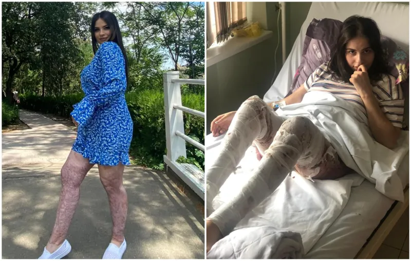 მას შემდეგ, რაც ცოცხლად დავიწვი, ღმერთის გარდა აღარავის მეშინია… დამნაშავეს 5 წელი მოაკლეს პატიმრობის” – როგორ ცხოვრობს გოგონა, რომელიც 5 წლის წინ შეყვარებულმა სასიკვდილოდ გაიმეტა